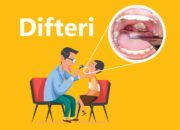 Dinkes HST Ingatkan Masyarakat Waspadai Penyakit Difteri yang Berpotensi Berbahaya