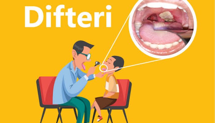 Dinkes HST Ingatkan Masyarakat Waspadai Penyakit Difteri yang Berpotensi Berbahaya